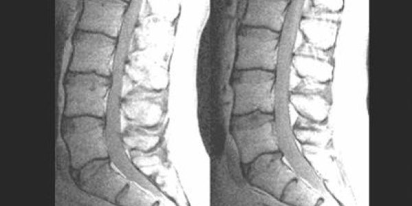 Back Pain May Be Genetic - Study
