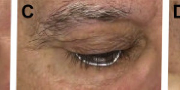 Glaucoma Drug Delivery Device Meters Out Eye Medication For Six Months