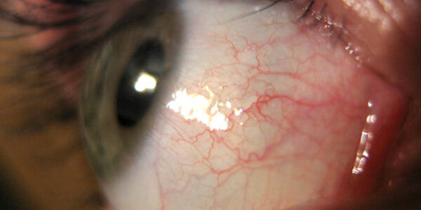 Article teaser image