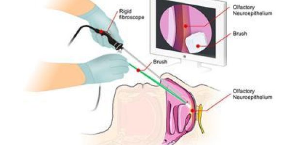 Nasal Brush Test For Creutzfeldt-Jakob Disease