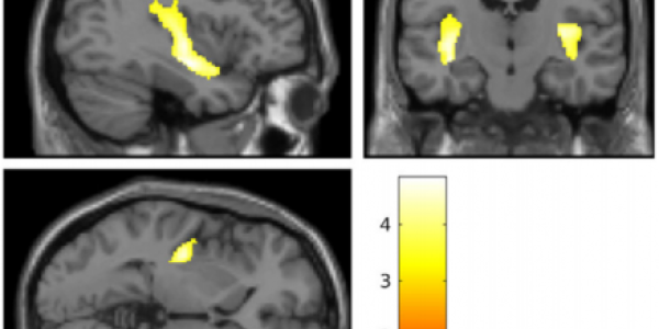 Brains Of Teenage Girls Who Engage In Cutting Are Similar To Those With Borderline Personality Disorder