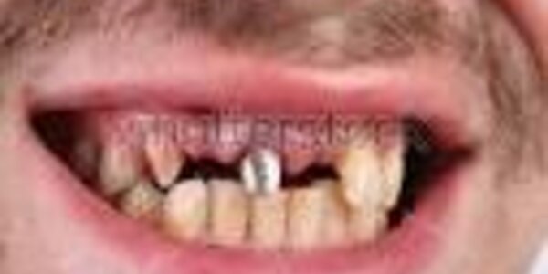 Article teaser image