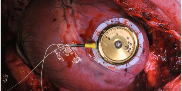 Article teaser image