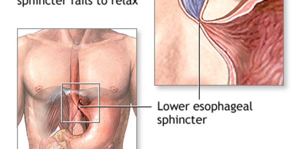 Article teaser image