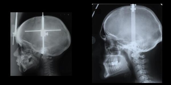 Article teaser image