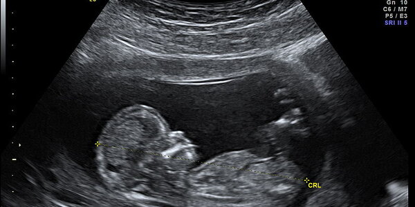 Article teaser image